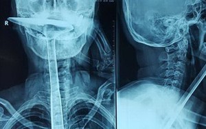 Hãi hùng cách chữa khó thở bằng xẻng đầy ngô nghê ở Trung Quốc