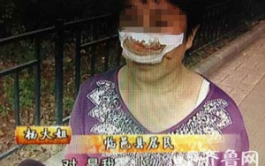 Cắn đứt mũi vợ vì không chịu nghe điện thoại