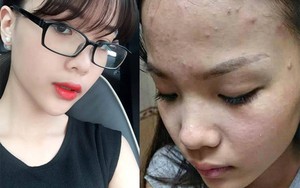 Cô gái xinh đẹp vẽ henna bị dị ứng nặng vì đồ trang điểm dởm