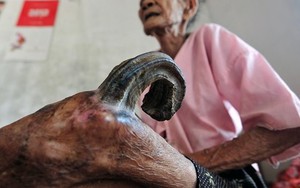 Sừng cong vút mọc ở chân, cụ bà người Nam Định thọ gần 100 tuổi