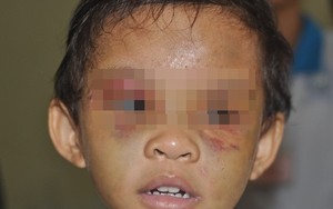 Bé bị mẹ và người tình hành hạ chấn động Bình Dương giờ ra sao?