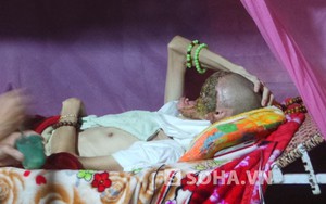 Tận cùng đau khổ của người đàn ông bị "ăn" hết nửa khuôn mặt
