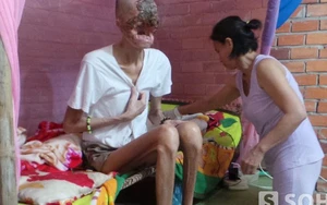 Người đàn ông bị "ăn" mòn nửa khuôn mặt mắc bệnh Cam Tẩu Mã