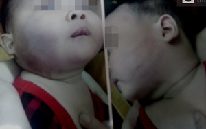 Cháu bé bị bầm khắp người khi rời nhà trẻ: Bảo mẫu nói gì?
