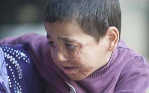Xót xa khuôn mặt đầy sẹo của bé trai sau cuộc tấn công tại Syria