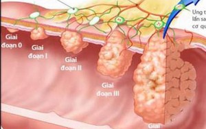 Bé 8 tuổi tìm ra cách chữa ung thư hiệu quả