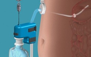 Chiếc máy "kinh dị" cắm thẳng ống hút vào dạ dày
