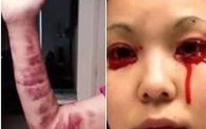 Mắc bệnh lạ, cô gái thường xuyên bị chảy máu mắt, miệng