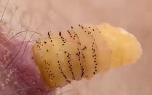 Nhà khoa học tự nuôi giòi trong cơ thể để nghiên cứu