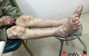 Suy thận vì điều trị gout ở phòng khám đông y Trung Quốc