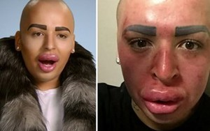Mặt biến dạng khủng khiếp vì phẫu thuật cho giống Kim Kardashian