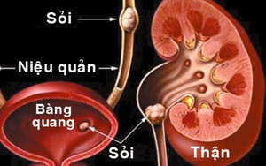 Trị sỏi thận bằng bài thuốc cực đơn giản chỉ 7 ngày ra hết sỏi