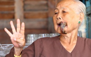 Cụ bà 87 tuổi bị phần thịt dư cả tấc ở miệng