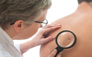Những nốt ruồi báo trước bệnh tật