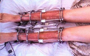 Quy trình phẫu thuật kéo dài chân "xem là sợ chân dài"