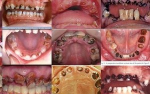 Cận cảnh sự phá hoại kinh hoàng của thuốc lá tới hàm răng