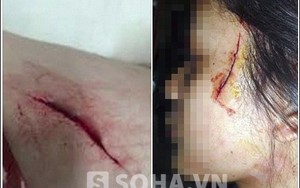 Tin đồn cô gái bị cướp rạch mặt ở HN khiến nhiều người hoang mang