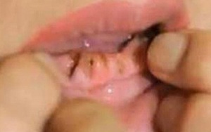 Nha chu: Căn bệnh răng miệng nguy hiểm nhất bạn phải biết