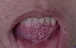 Vợ la khóc khi đốt sùi mào gà, chồng che mặt xấu hổ