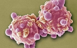 Những dấu hiệu ban đầu của bệnh ung thư thường bị làm ngơ