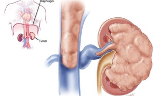 Không chỉ phổi, cả tim mạch, thận cũng bị "giết chết" bởi thứ này