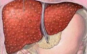 Bỗng dưng mắc bệnh "tế nhị", bạn gái nằng nặc đòi chia tay