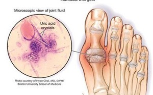 Thói quen không ngờ khiến người Việt mắc bệnh gout mà không biết