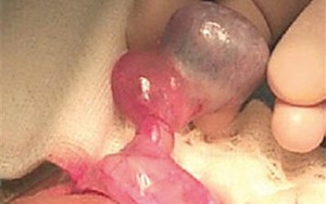Căn bệnh không đau đớn nhưng có thể khiến nam giới bị vô sinh
