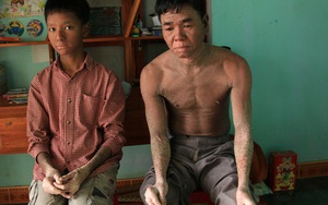 Cậu bé "người rắn" ở Quảng Nam: Hồi trước các bạn bỏ chạy vì sợ, nhưng giờ nhiều bạn thân với con lắm".