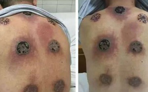 Rùng mình với tấm lưng lỗ chỗ vết bỏng nhiễm trùng do giác hơi