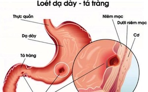 Cảnh báo nguy cơ viêm loét dạ dày tăng cao khi trời chuyển mùa