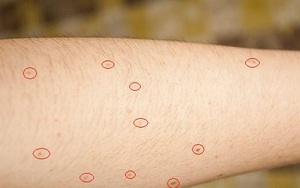 Cảnh báo ung thư da từ số lượng nốt ruồi trên cánh tay phải