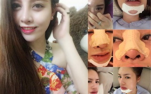 "Cơn ác mộng" của 9x xinh đẹp sau khi tiêm chất filler