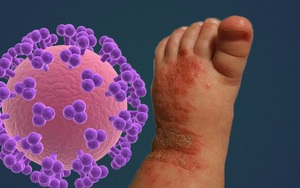 14 tháng tuổi bị nhiễm virus Herpes cả đời do nụ hôn từ người lớn