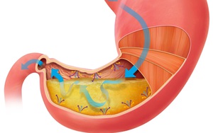 Sống khỏe sau khi bị xung huyết dạ dày và 4 lần cắt polip