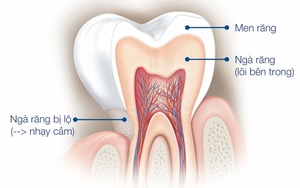 Răng nhạy cảm: Vấn đề đáng báo động