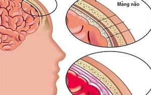Viêm màng não: Dấu hiệu ít ai ngờ