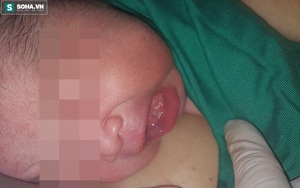 Hi hữu tại TP.HCM: Vừa chào đời, bé gái đã có 2 chiếc răng cửa