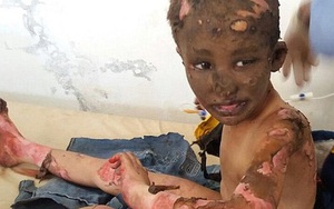 "Đây là Syria, không phải Việt Nam" - Loạt ảnh xé lòng về những đứa trẻ bị thiêu đốt trong trận không kích bằng napalm