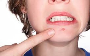 Nguy cơ bệnh tật tiềm ẩn đằng sau những nốt mụn ít người để ý