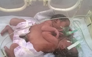 Tin mới về sức khỏe cặp song sinh được bác sĩ ra chợ xin từ thiện