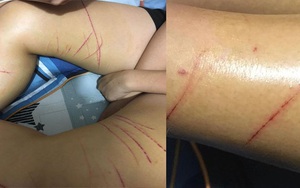 Công an Hà Nội nói về nghi vấn cô gái bị kẻ "biến thái" quấy rối, rạch đùi giữa phố