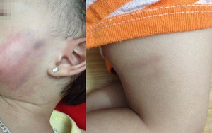 Bé gái 16 tháng tuổi thâm tím khắp cơ thể sau khi ở trường về