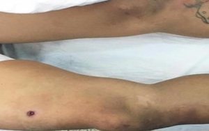 Thanh niên 'ngáo đá' bị bắn đạn cao su thủng đùi