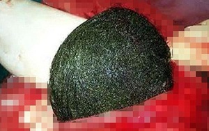 Phát hiện búi tóc lớn bằng quả dưa trong bụng một người phụ nữ