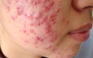 Cảnh báo vô sinh vì lạm dụng thuốc để điều trị bệnh hay gặp này