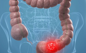 7 dấu hiệu cảnh báo bạn đang bị ung thư đại trực tràng