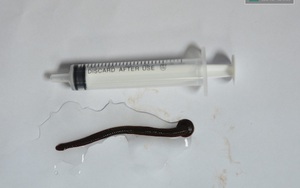 Kinh hãi con đỉa dài 7cm sống 2 tháng trong mũi cụ bà ở Nghệ An