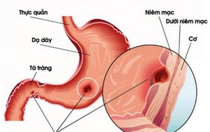 7 bí quyết bảo vệ dạ dày hiệu quả nhất ai cũng nên biết