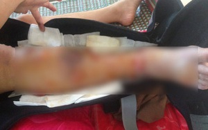 Đau đớn nữ sinh mất chân vì bệnh viện tắc trách